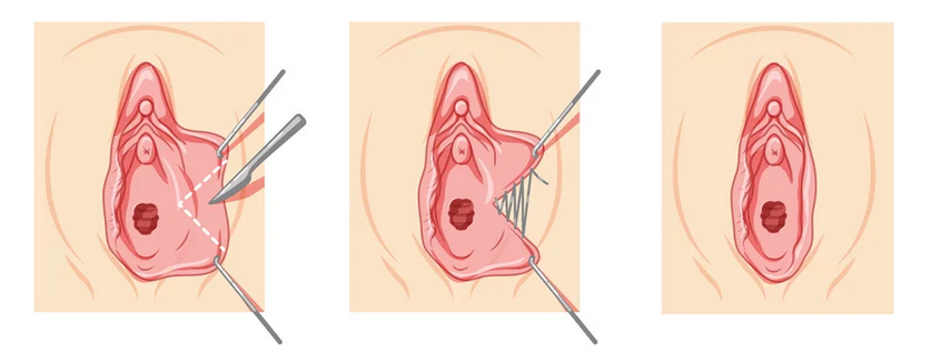 labioplastica come si esegue